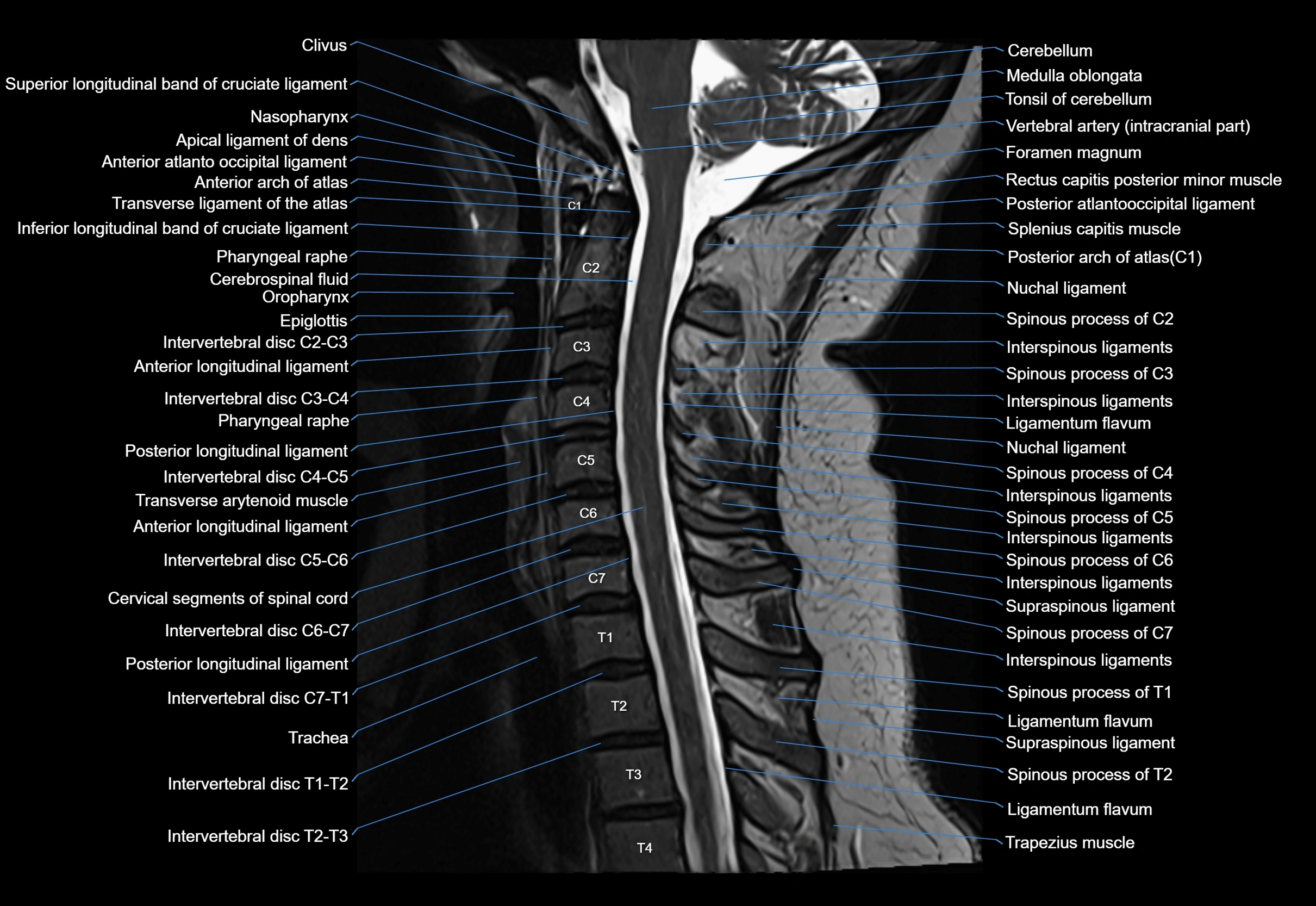 cervical spine cross sectional MRI anatomy 3T MRI  sagittal image-img-00001-00016.webp